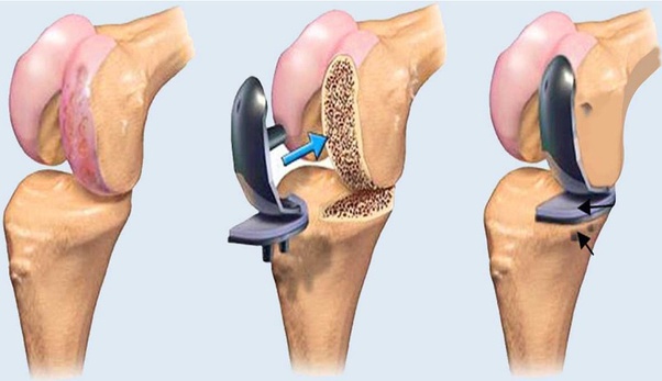 Best Orthopedic in Prayagraj – Shanti Vilas Hospital